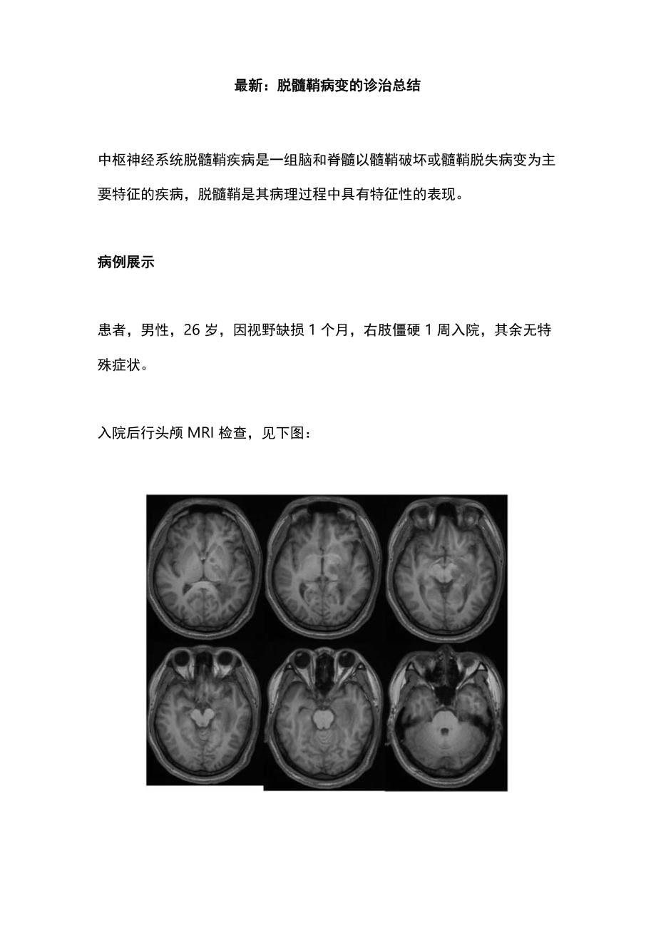 最新：脱髓鞘病变的诊治总结.docx_第1页