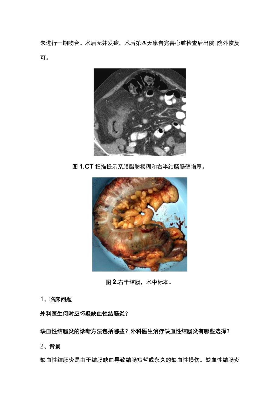 最新：缺血性结肠炎的诊断和治疗.docx_第2页