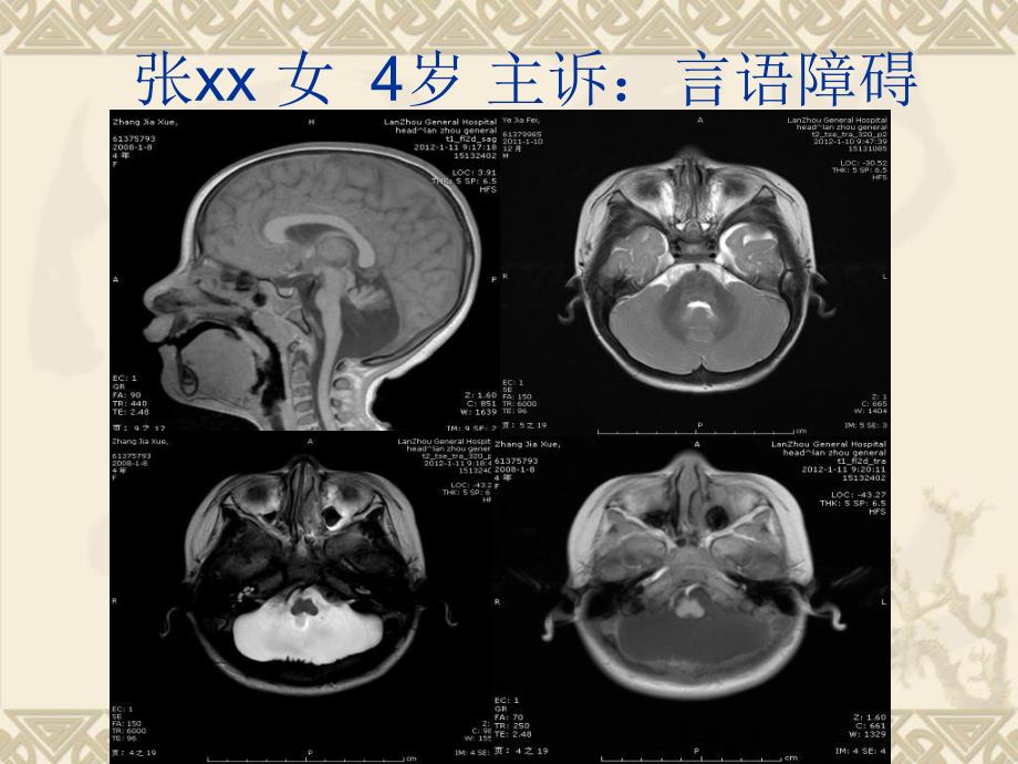 颅脑先天发育畸形两例1.ppt_第2页