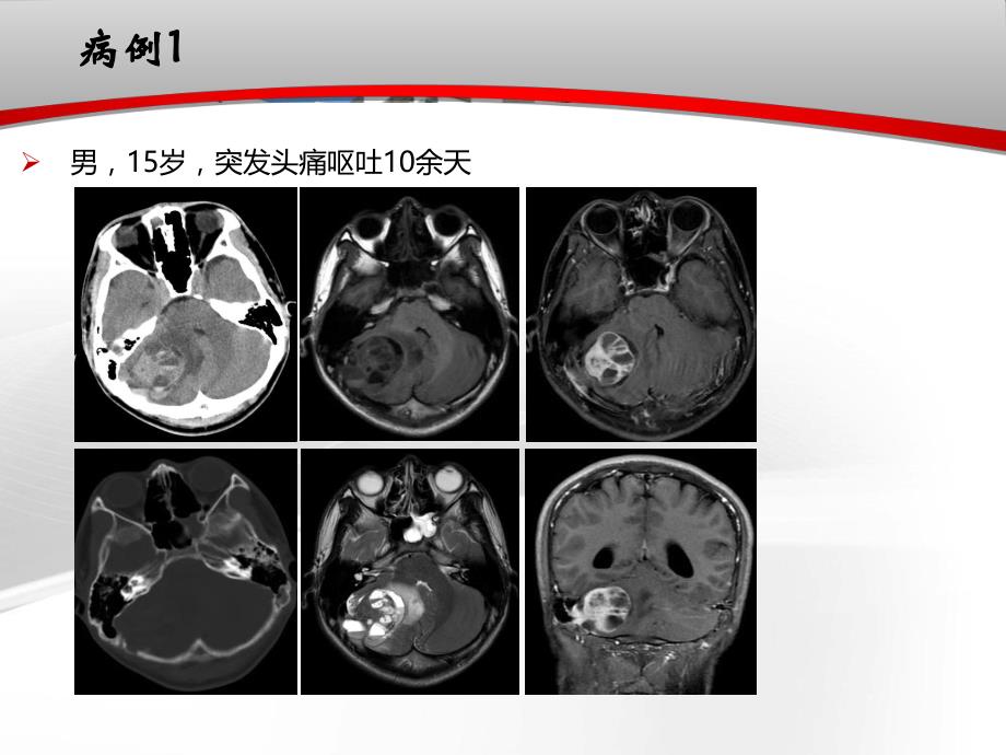 颅骨肿瘤影像学表现.ppt_第2页