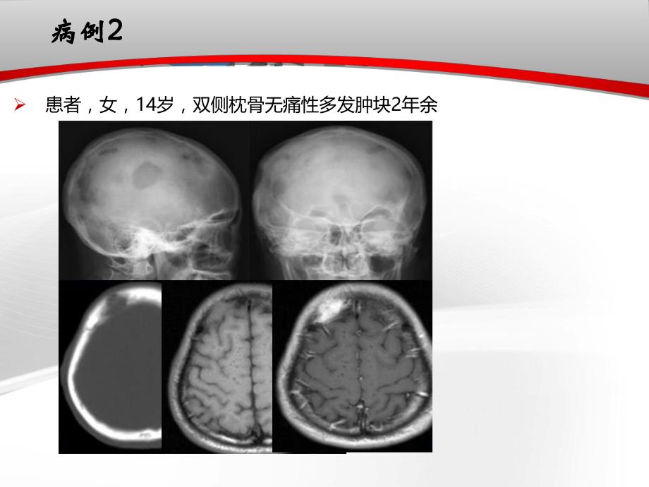 颅骨肿瘤影像学表现.ppt_第3页