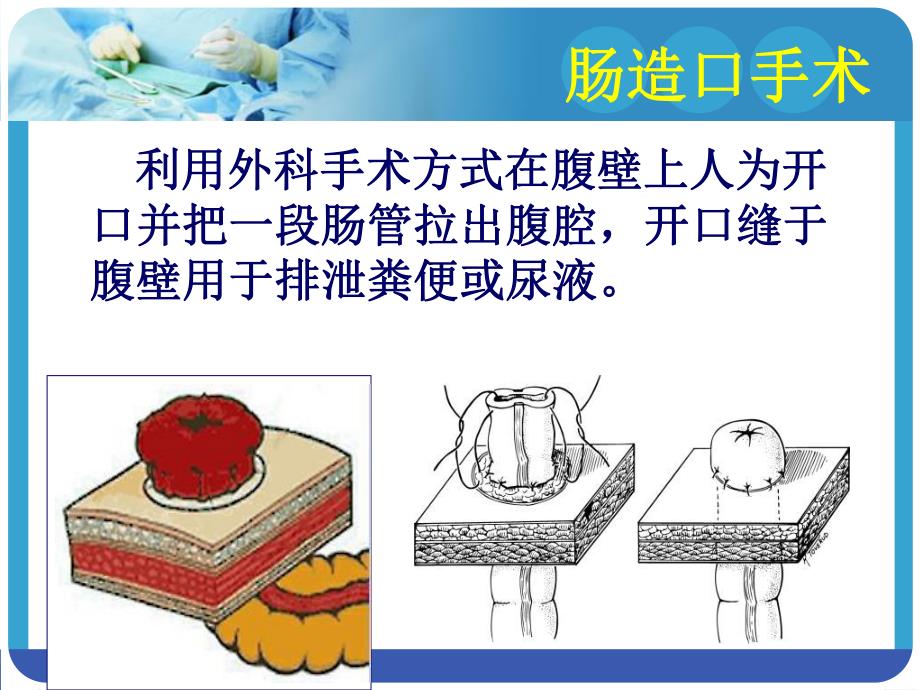 造口术前定位.ppt_第2页