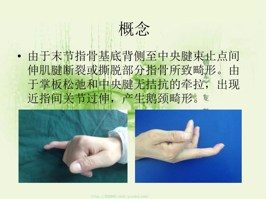 锤状指的保守治疗.ppt_第3页