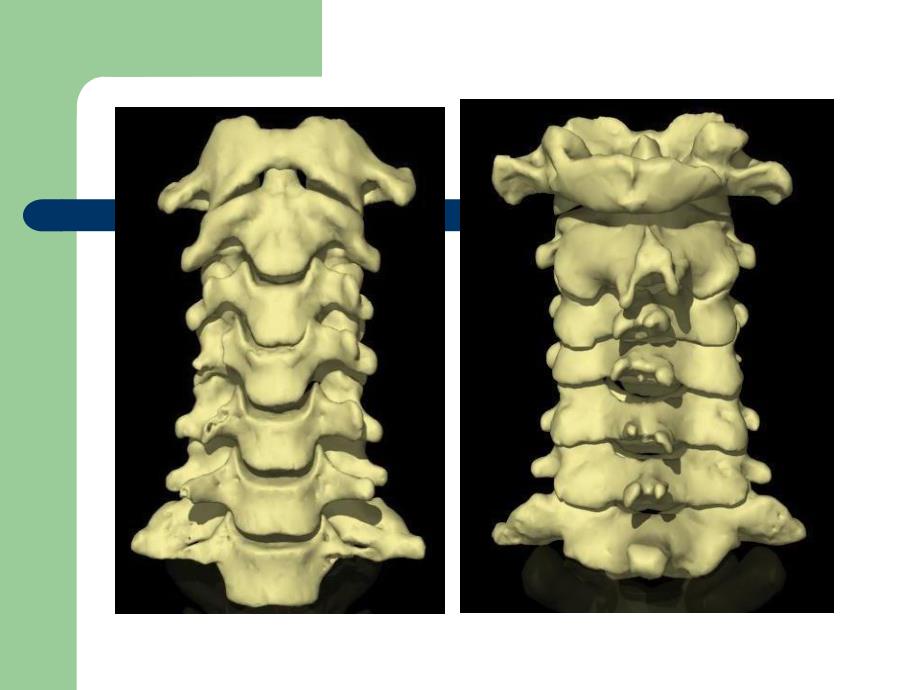 颈椎病的临床康复.ppt_第3页