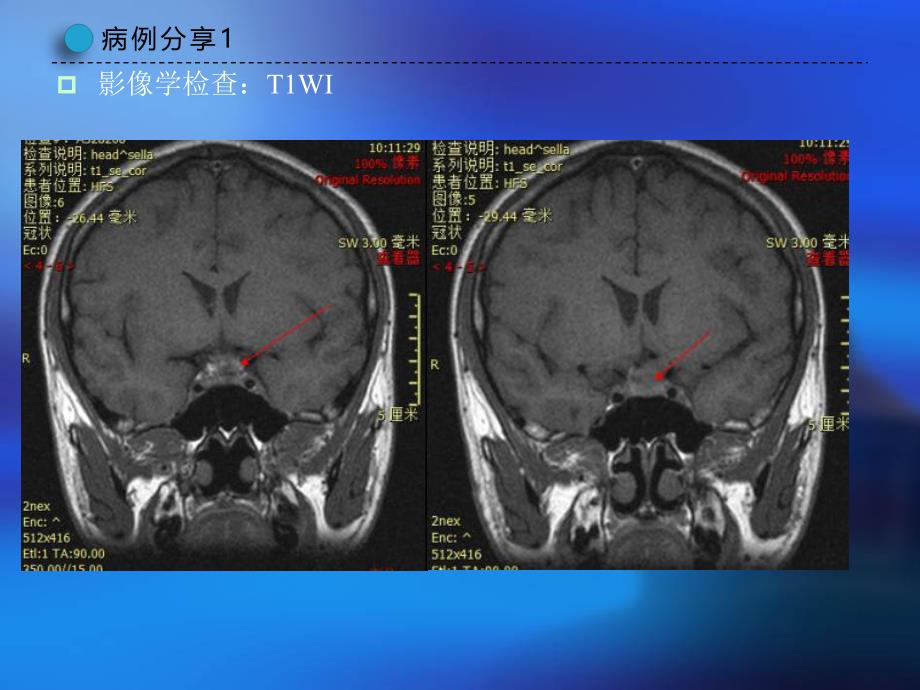 朗格汉斯细胞组织细胞增生症.pptx_第3页