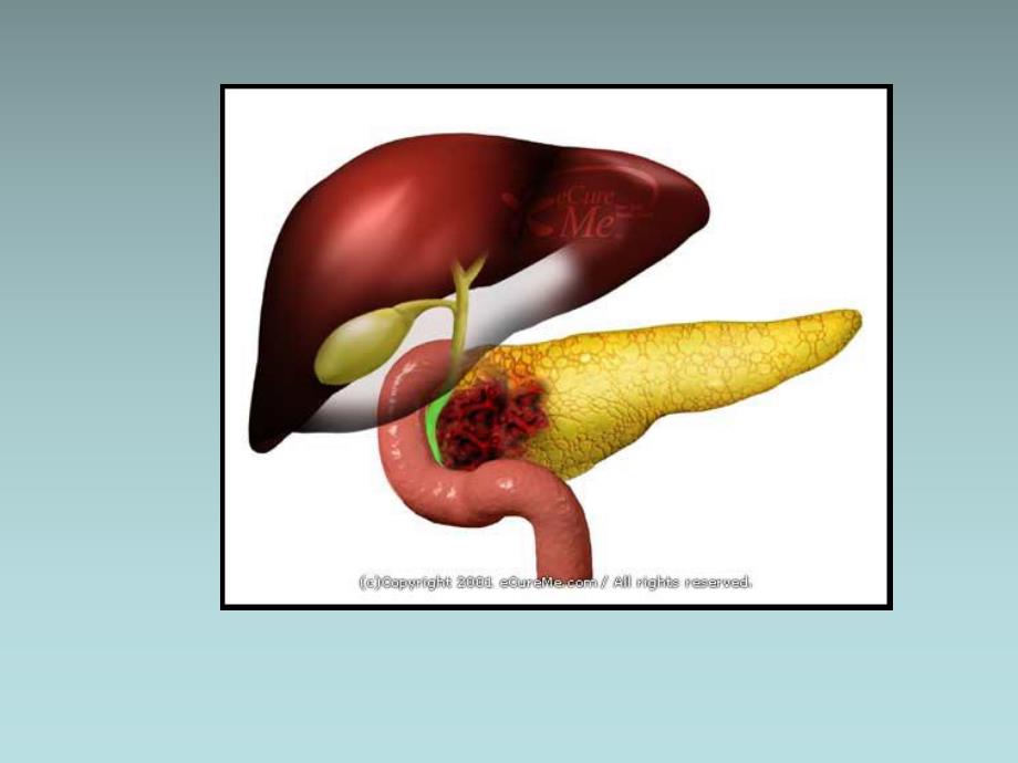 胰腺癌病人的护理.ppt_第3页