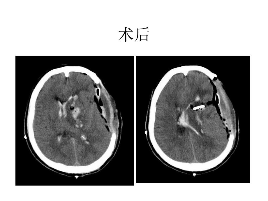 脑外科教学查房.ppt_第3页