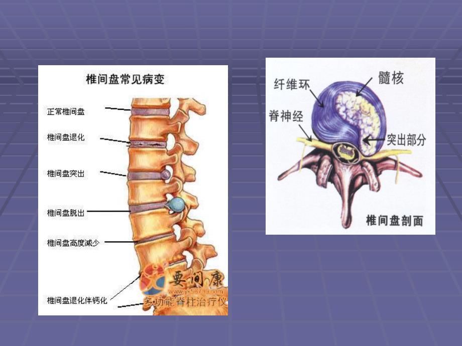 腰椎间盘突出症全解.ppt_第2页