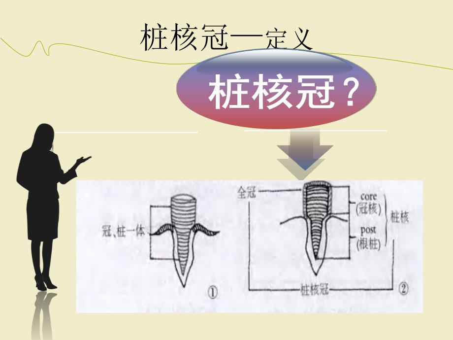 桩核冠修复浅析.ppt_第3页