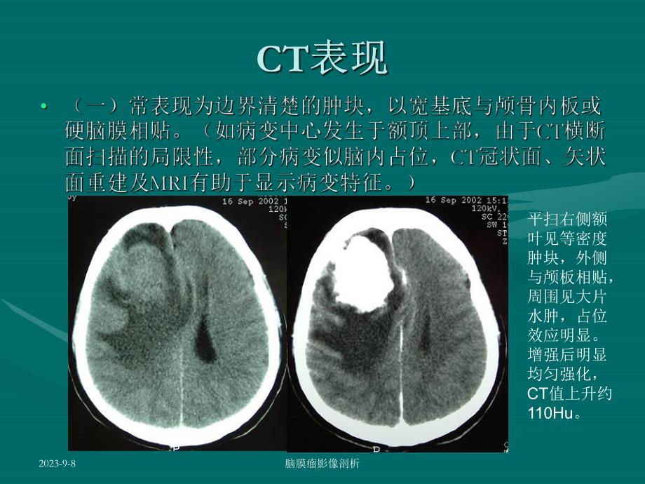 脑膜瘤CTMRI表现.ppt_第3页