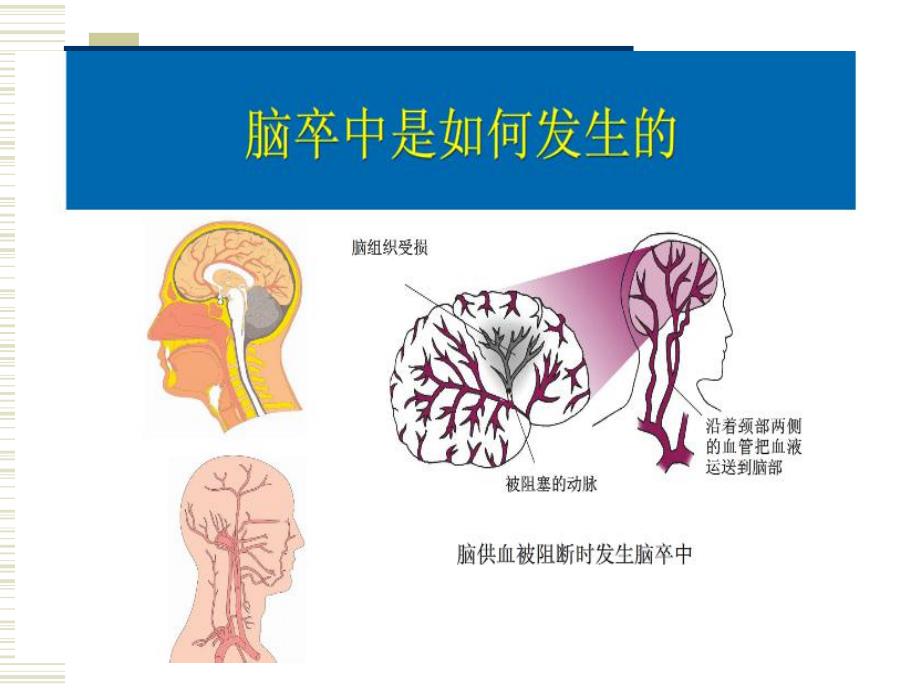 脑卒中介绍.ppt_第3页