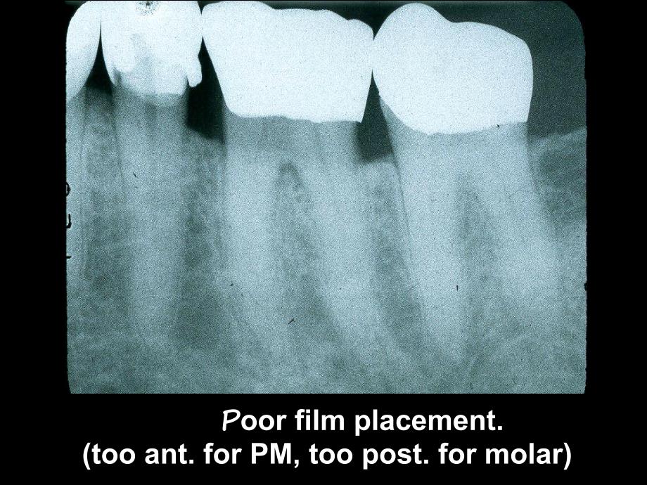 intraoraltecherrors学会看拍牙片.ppt_第3页