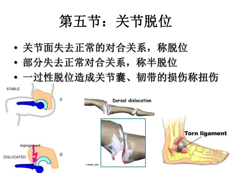 第五节关节脱位.ppt_第1页