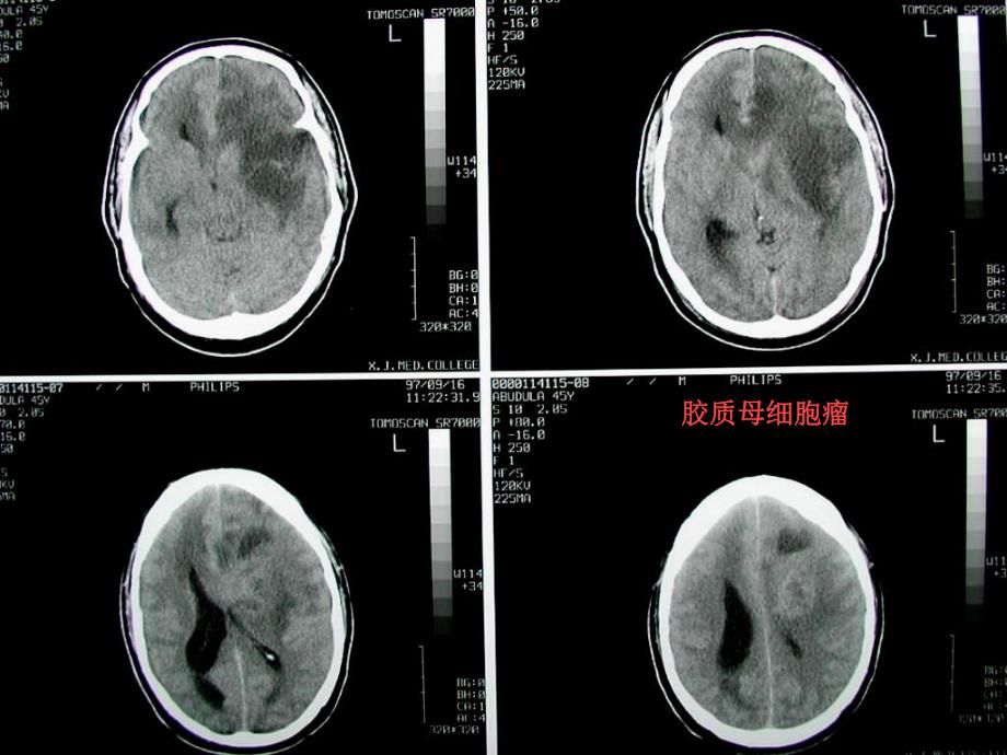 脑部疾病诊断1.ppt_第3页