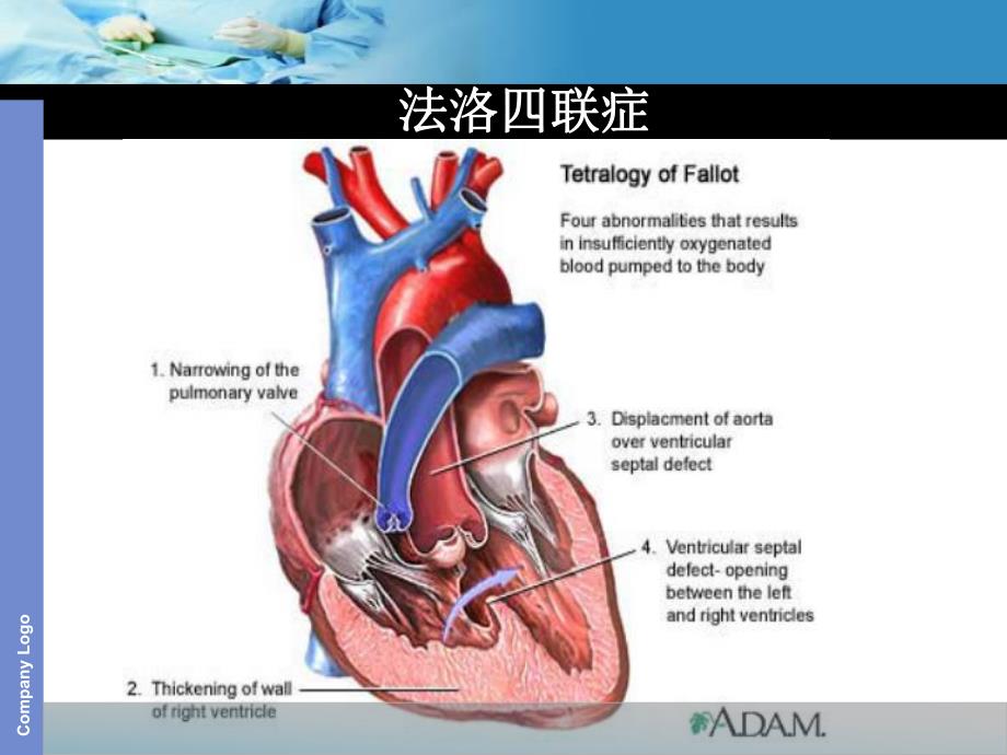 tof法洛四联症ppt课件.ppt_第3页