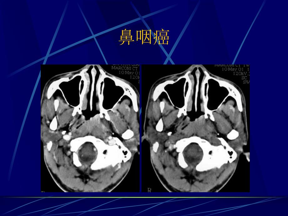 咽部影像诊断.ppt_第2页