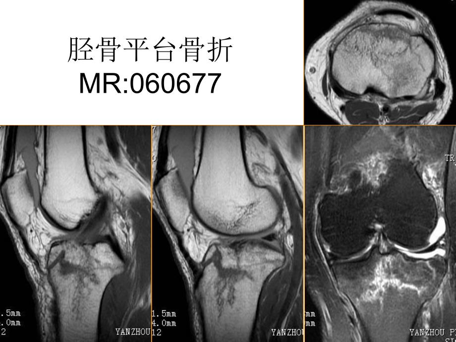 脊柱骨胳系统MRI图片.ppt_第3页