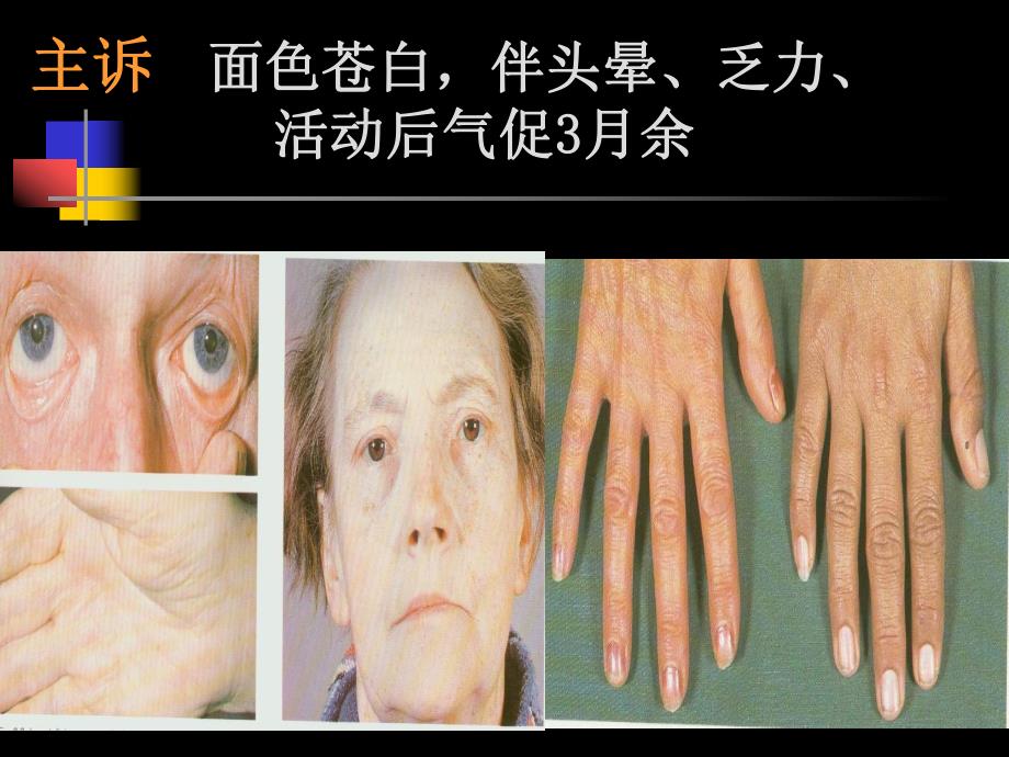 贫血anemia.ppt_第1页