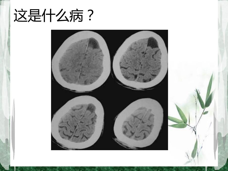 蛛网膜囊肿2.ppt_第3页