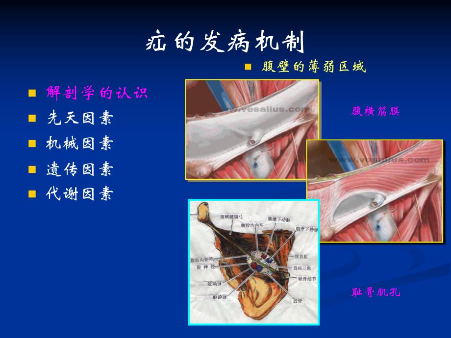 腹股沟疝ppt课件.ppt_第3页