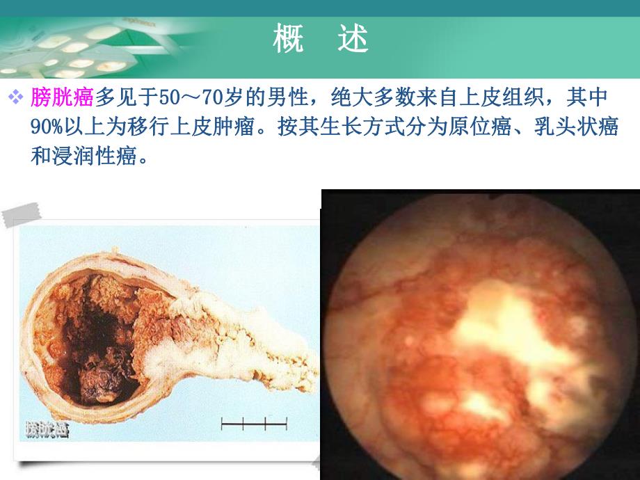 膀胱肿瘤病人的护理.ppt_第3页