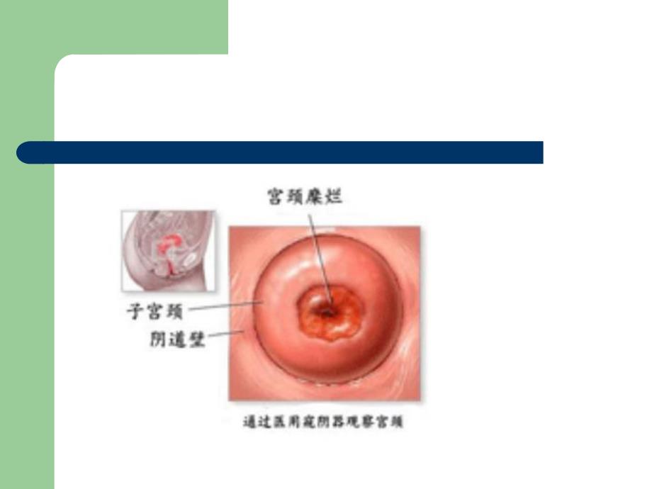 宫颈癌前病变.ppt_第3页