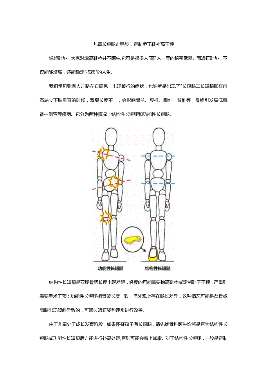 儿童长短腿走鸭步-定制矫正鞋补高干预.docx_第1页