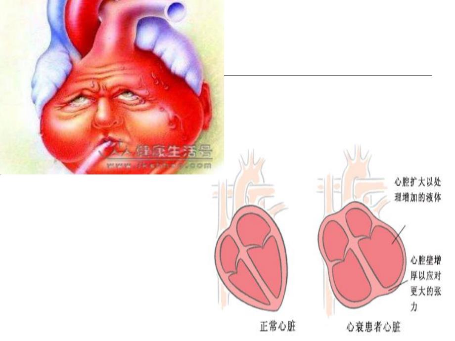 心力衰竭1.ppt_第3页