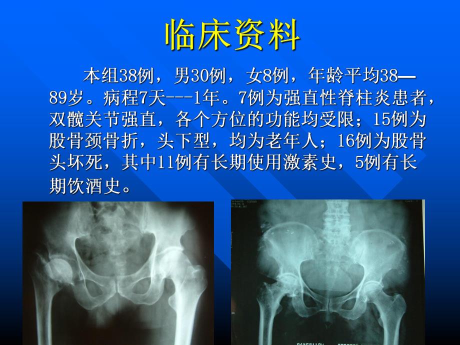 微创全髋置换初步认识.ppt_第3页