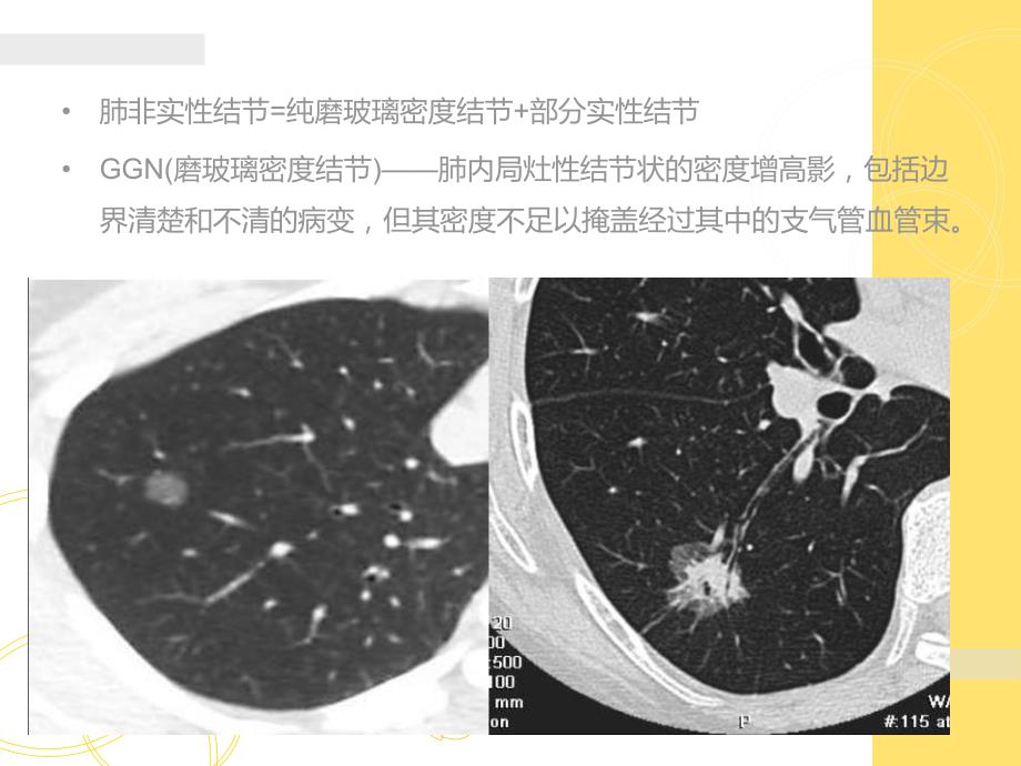 影像学专用修改稿讲课专用Fleischner肺非实性结节处理ppt.ppt_第2页