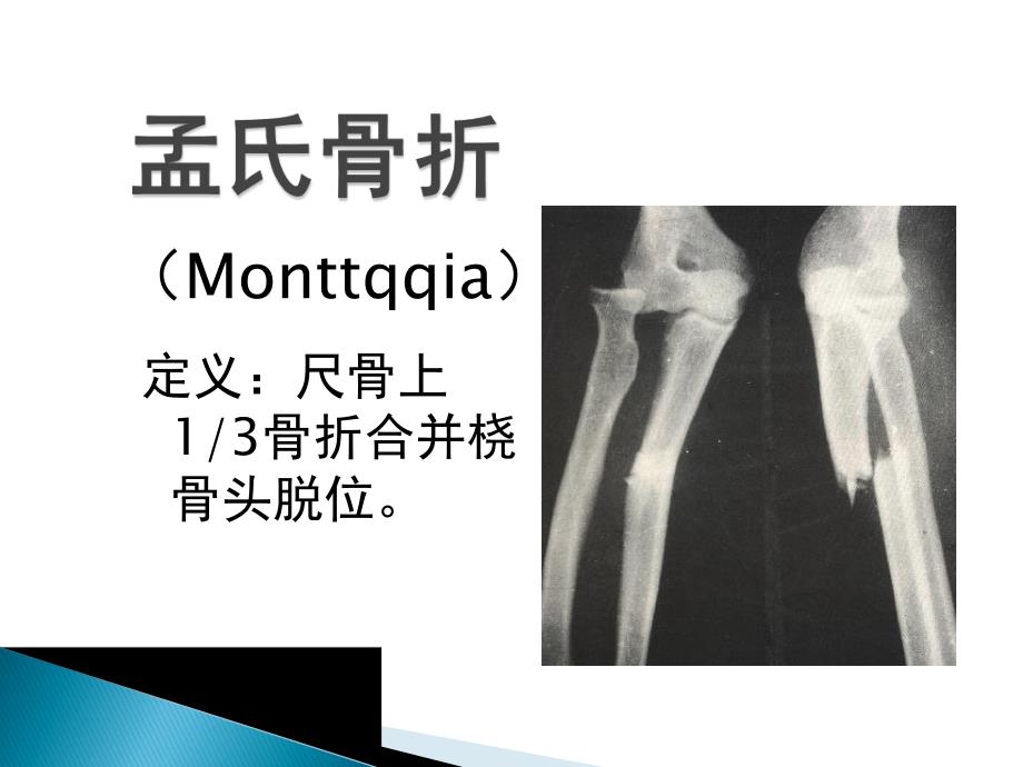 孟氏骨折与盖氏骨折.ppt_第1页