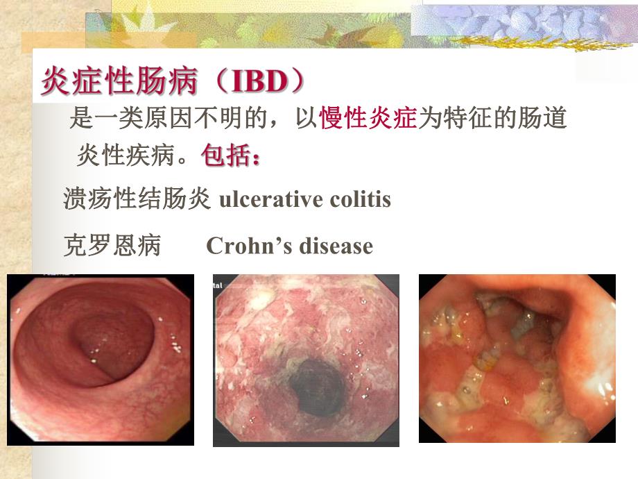 炎症性肠病3.ppt_第2页