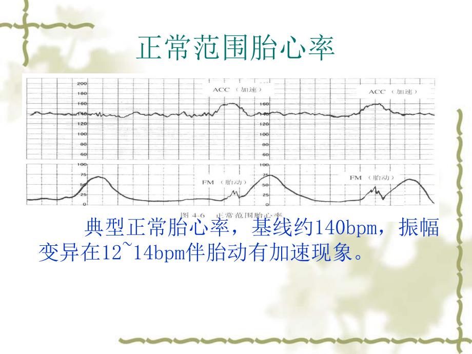 胎儿监护图像.ppt_第3页