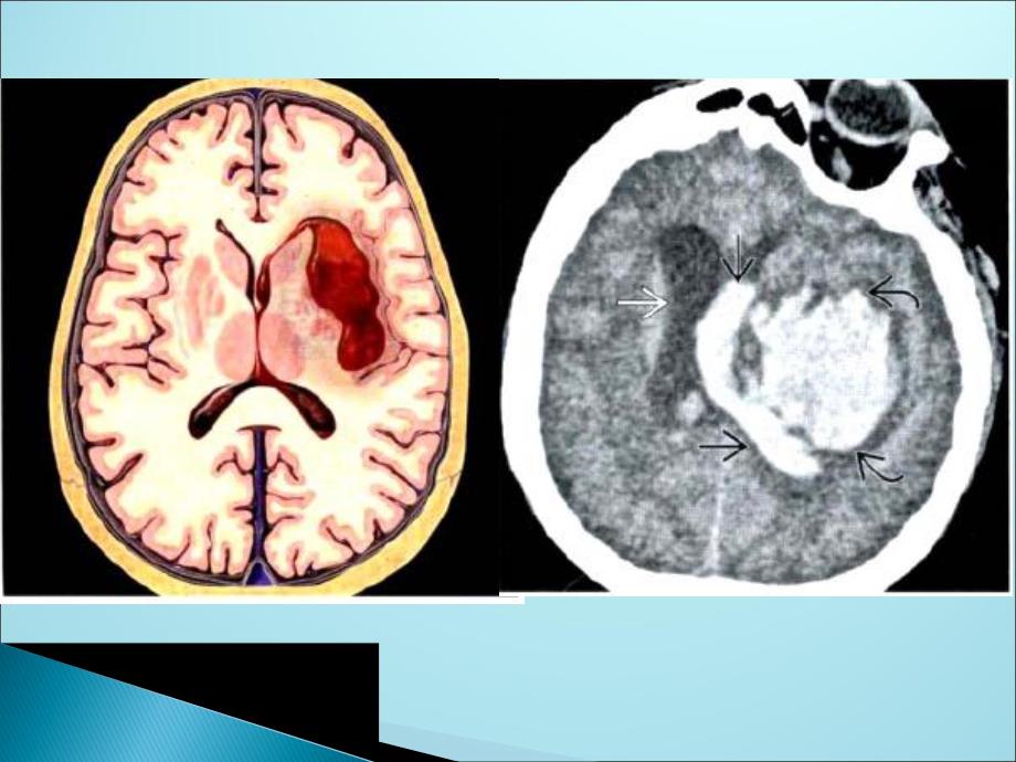高血压性脑出血1.ppt_第2页