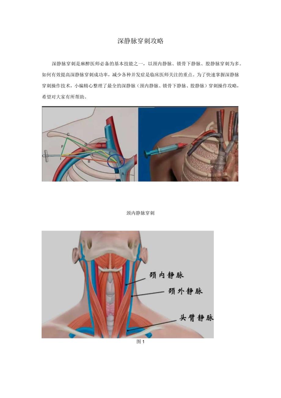 深静脉穿刺全攻略-深静脉穿刺全攻略.docx_第1页