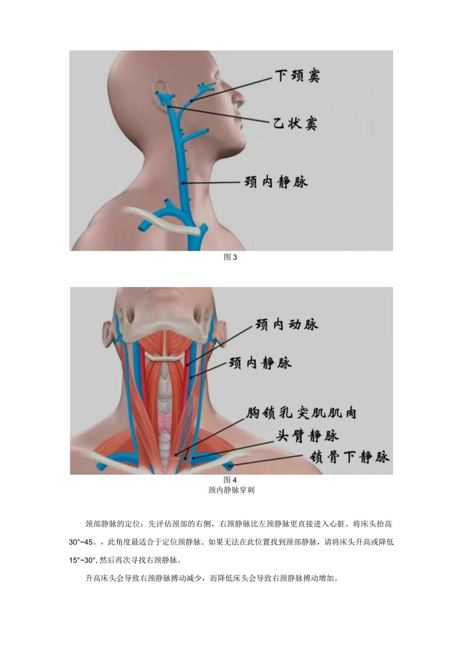 深静脉穿刺全攻略-深静脉穿刺全攻略.docx_第3页