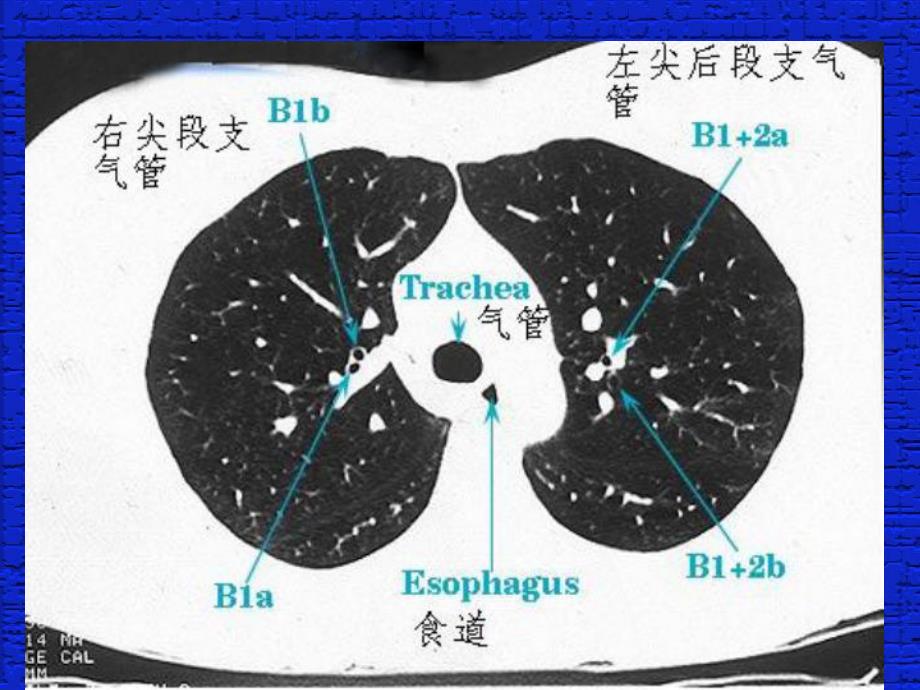 [医药卫生]肺段支气管CT读片.ppt_第2页