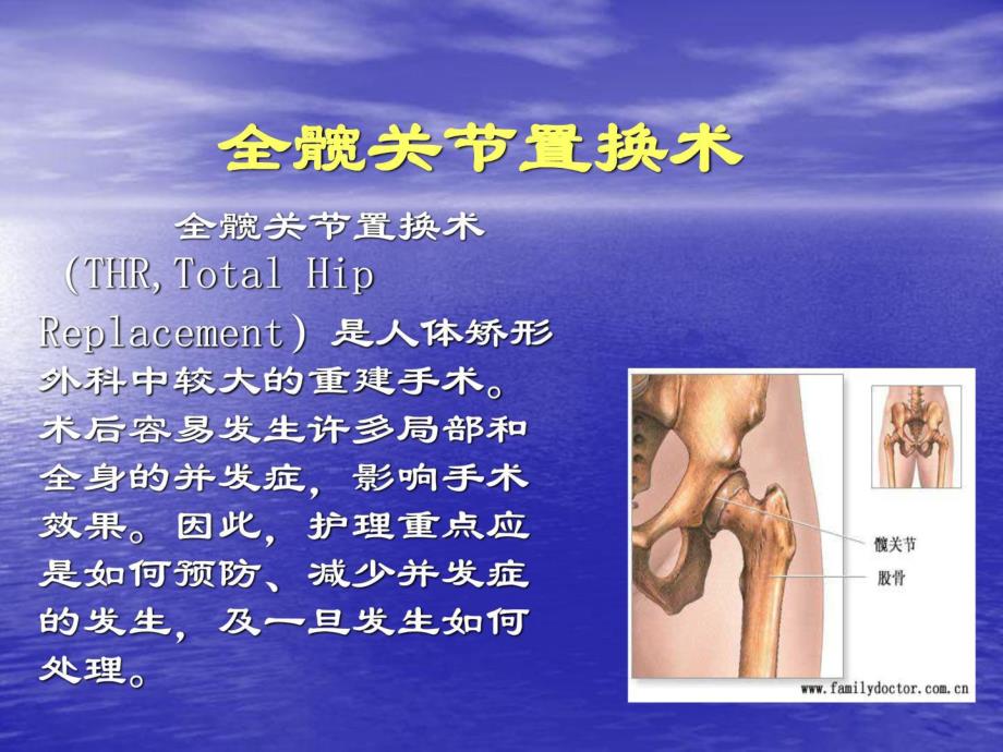 [宝典]人工髋关节置换术护理.ppt_第2页