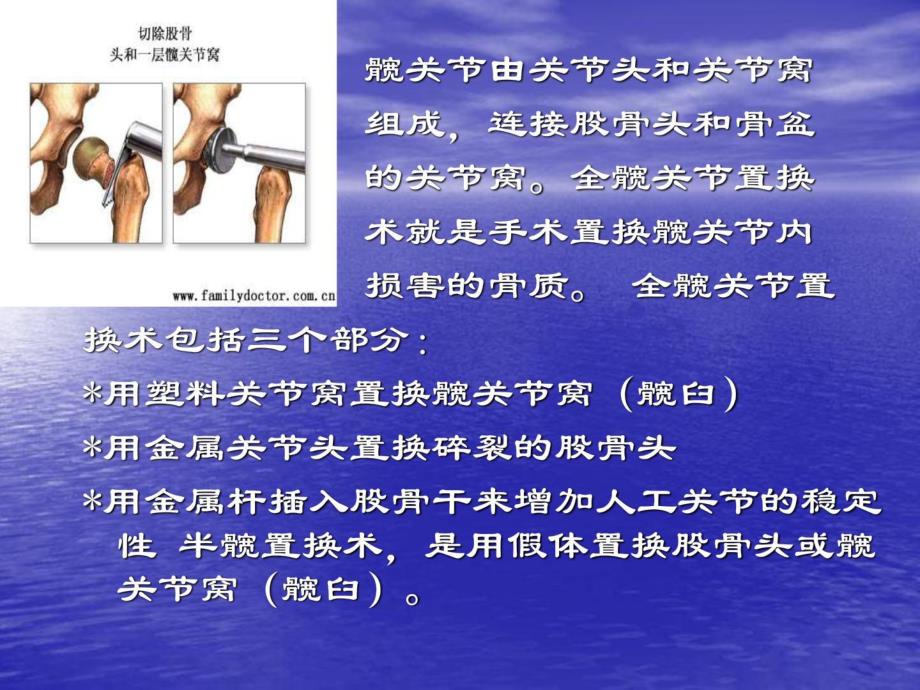 [宝典]人工髋关节置换术护理.ppt_第3页