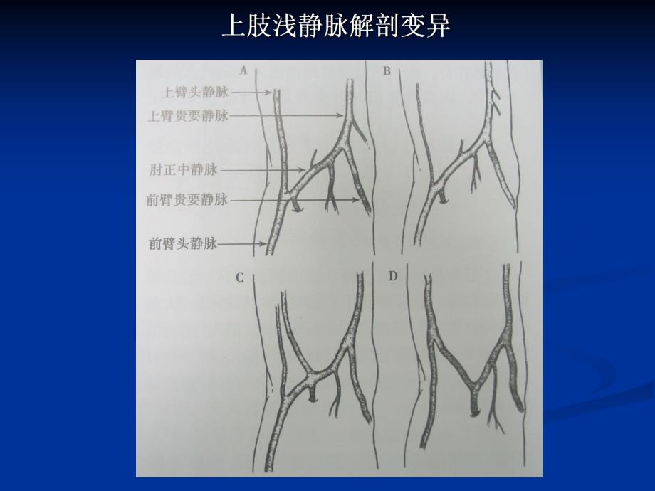 【精品】彩色多普勒超声在上肢浅静脉置管术中的应用.ppt_第3页