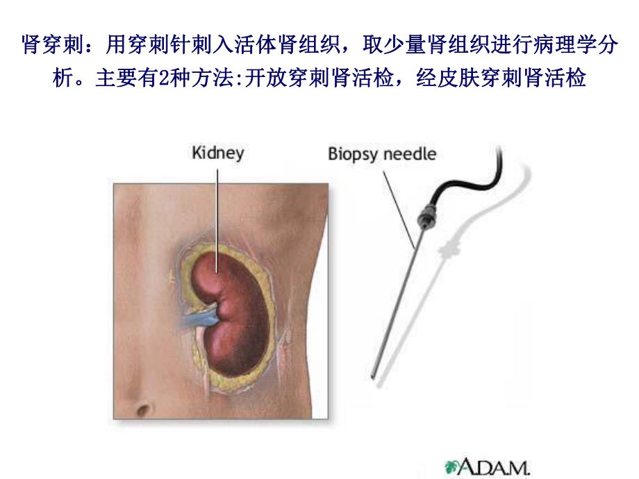 06.肾穿刺活检.ppt_第2页