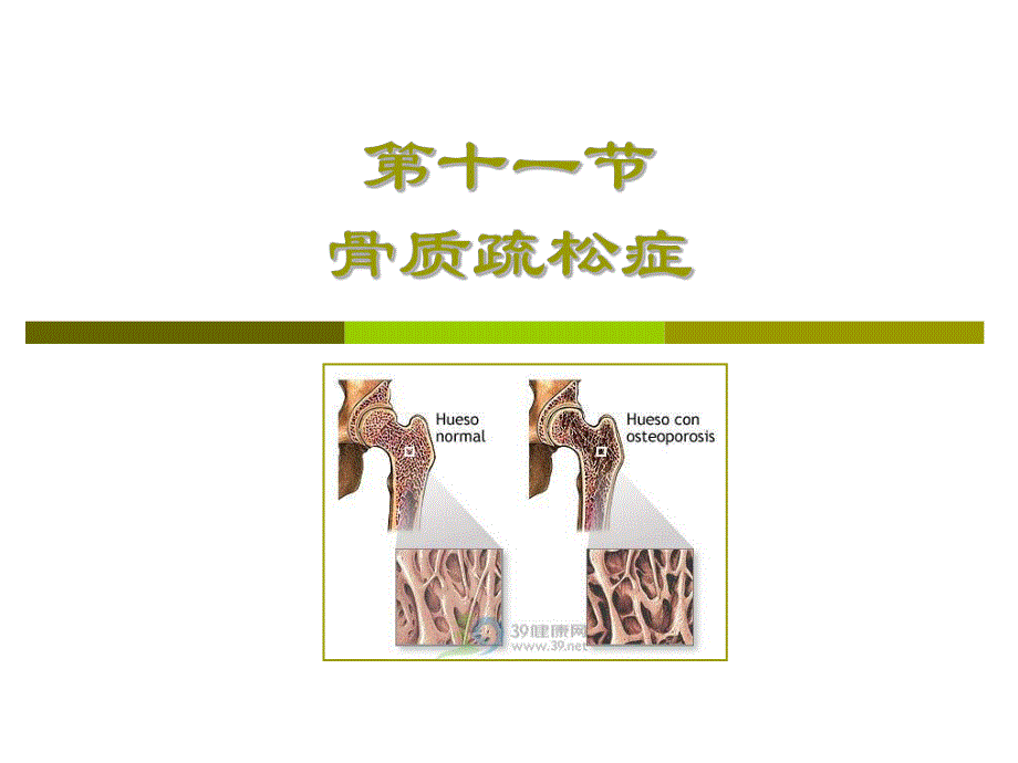 【精品】第十一节 骨质疏松症26.ppt_第1页