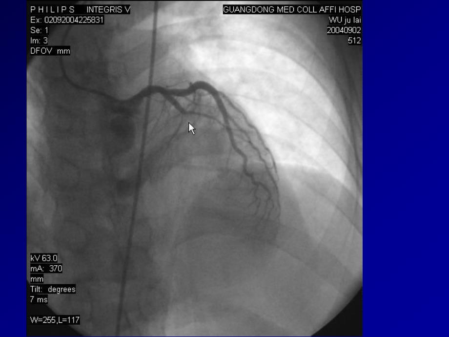 64排CT的冠状动脉成像.ppt_第3页