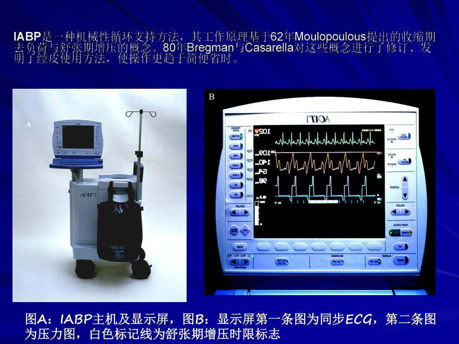 IABP主动脉内球囊反搏泵的临床使用.ppt_第2页