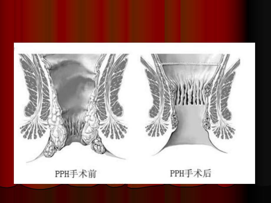 pph手术图文.ppt_第3页