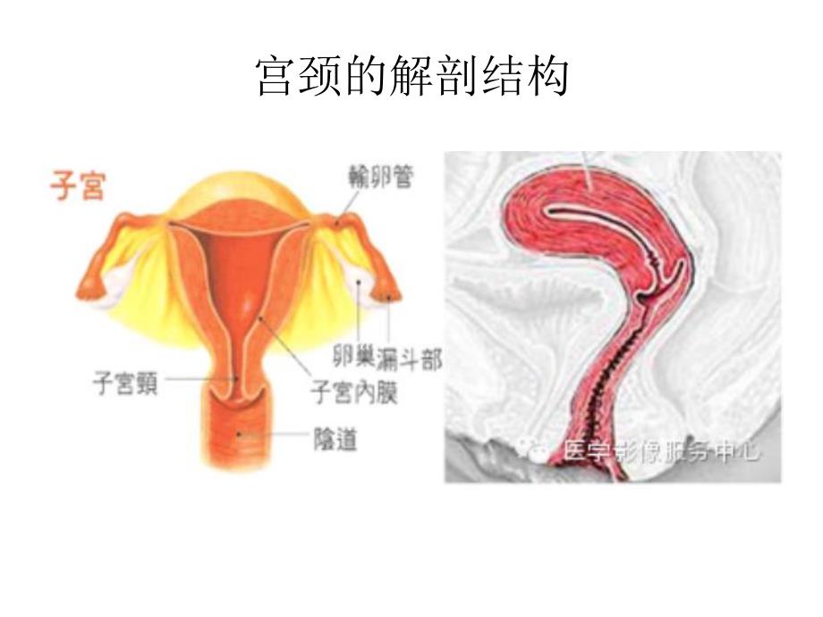 MRI在宫颈癌的临床应用.ppt_第3页