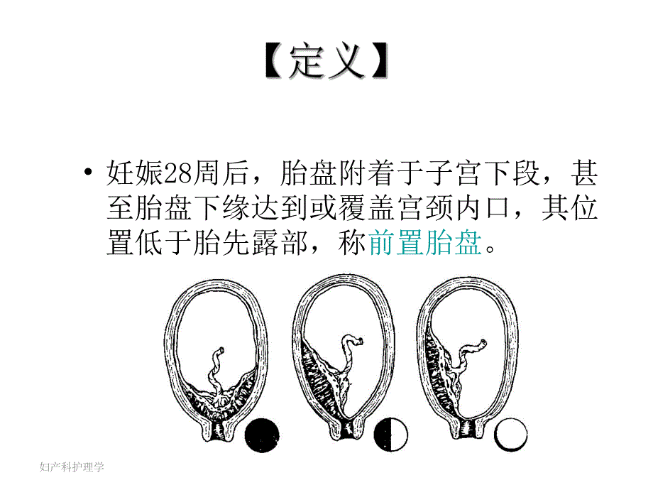 前置胎盘1.ppt_第3页