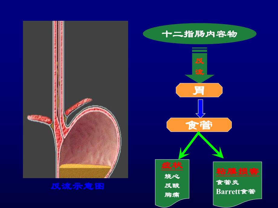 十二指肠胃反流与胆汁反流性疾病[1].ppt_第2页