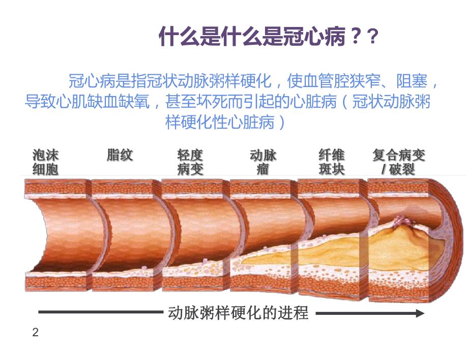 冠心病患者如何改善生活方式.ppt_第2页