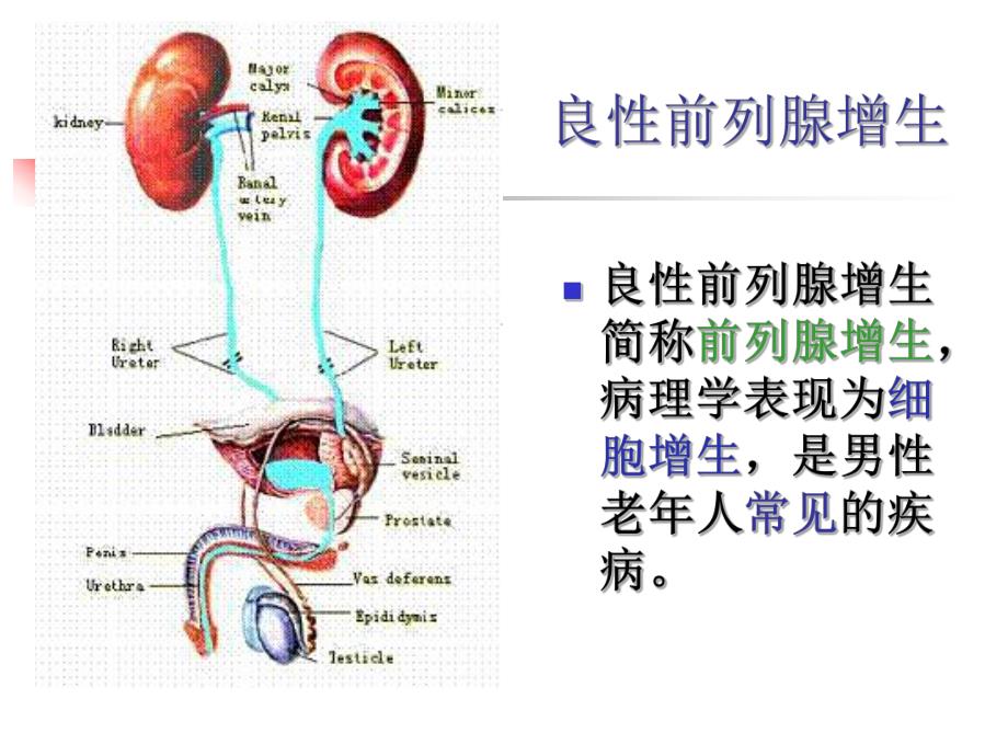 前列腺增生病人的护理.ppt_第2页